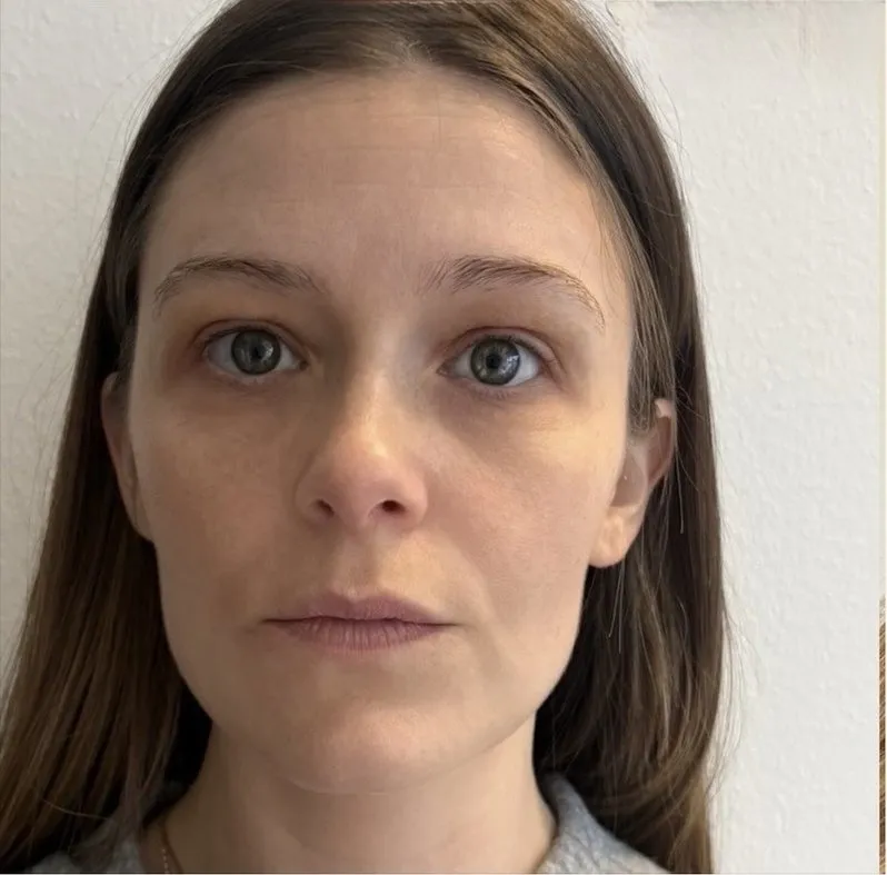Øjenparti før og efter botox-brynløft — før behandling