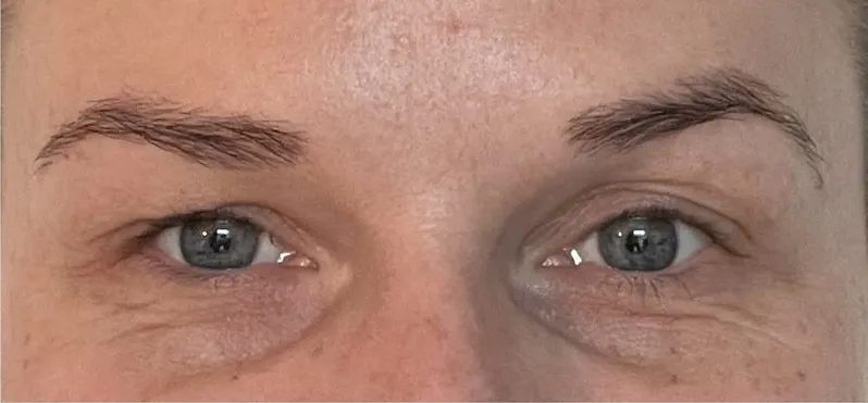 Bryn og øjenlåg før og efter botox-brynløft — efter behandling