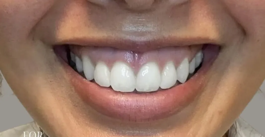 Tandkødssmil før og efter Botox — før behandling