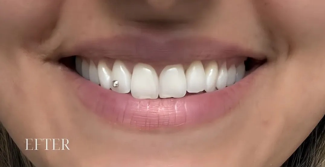 Overlæbe og smil før og efter lip flip med Botox — efter behandling