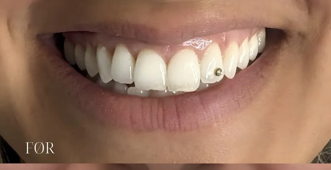 Overlæbe og smil før og efter lip flip med Botox — før behandling