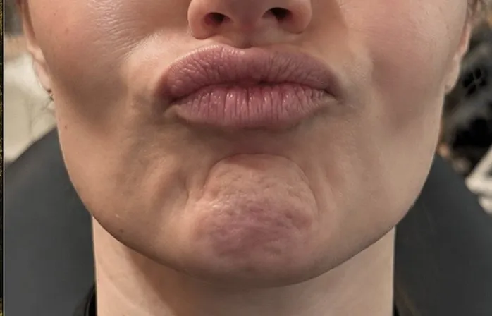 Hage før og efter Botox i mentalis-musklen — før behandling