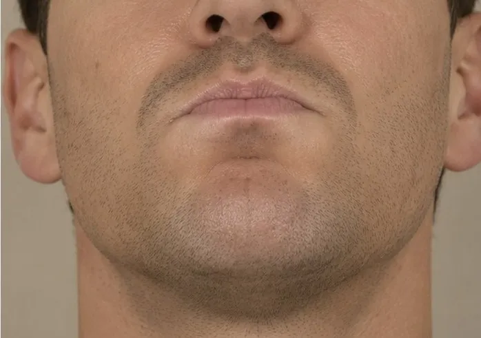 Hage før og efter Botox i mentalis-musklen — efter behandling