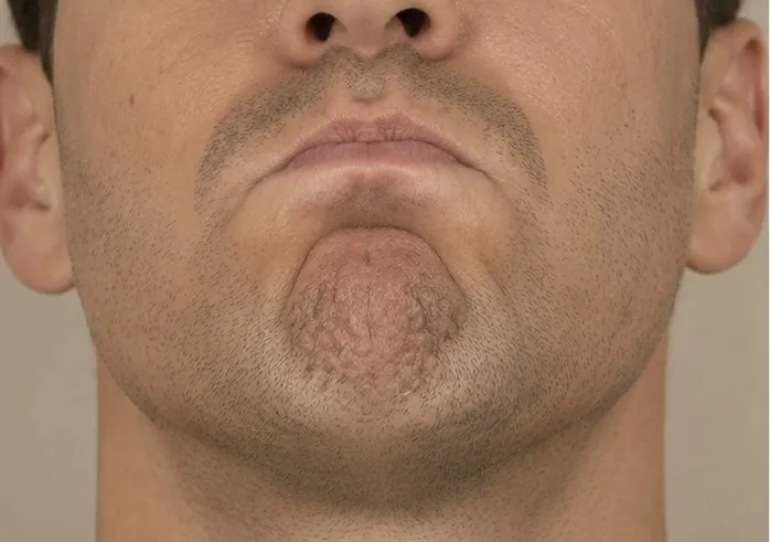 Hage før og efter Botox i mentalis-musklen — før behandling