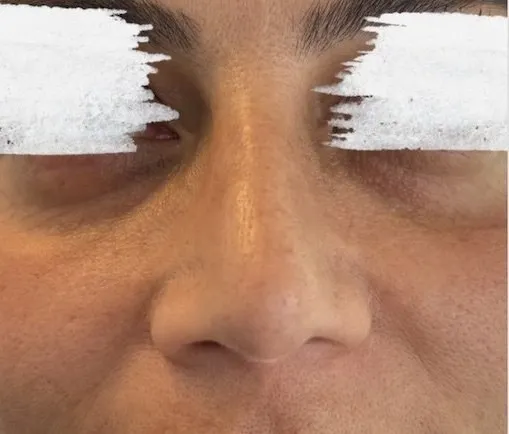 Næse før og efter nose slimming med Botox — efter behandling