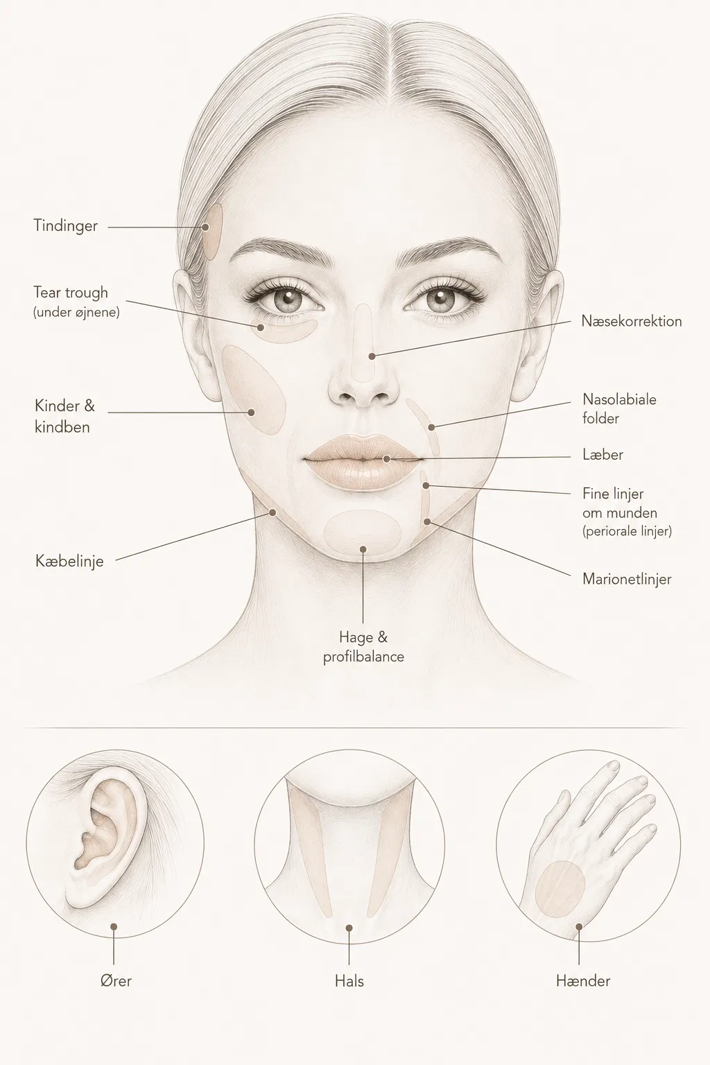 Illustration af de områder, der oftest behandles med filler: tindinger, tear trough, kinder og kindben, næsekorrektion, nasolabiale folder, læber, fine linjer om munden, marionetlinjer, kæbelinje, hage og profilbalance, ører, hals og hænder