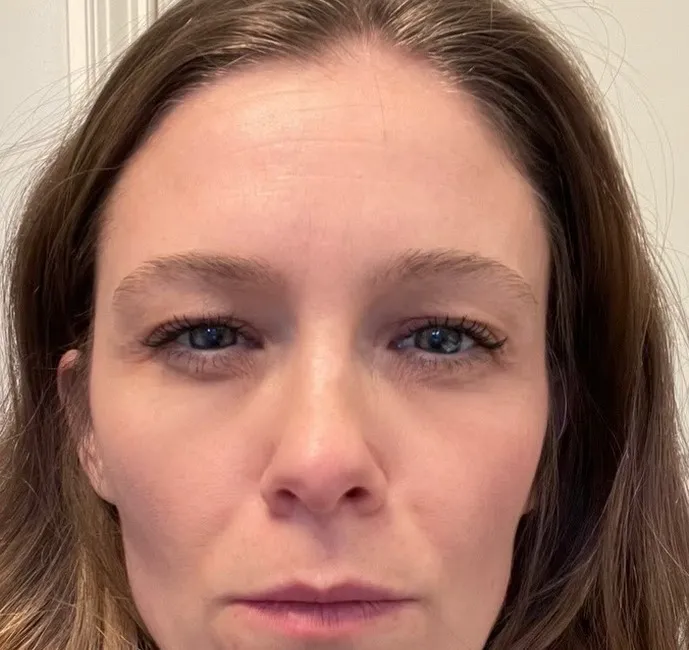 Bekymringslinjer mellem brynene — Botox — efter behandling