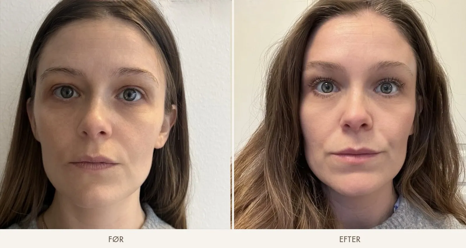 Ansigt før og efter Botox-brynløft — brynene står lettere efter behandlingen