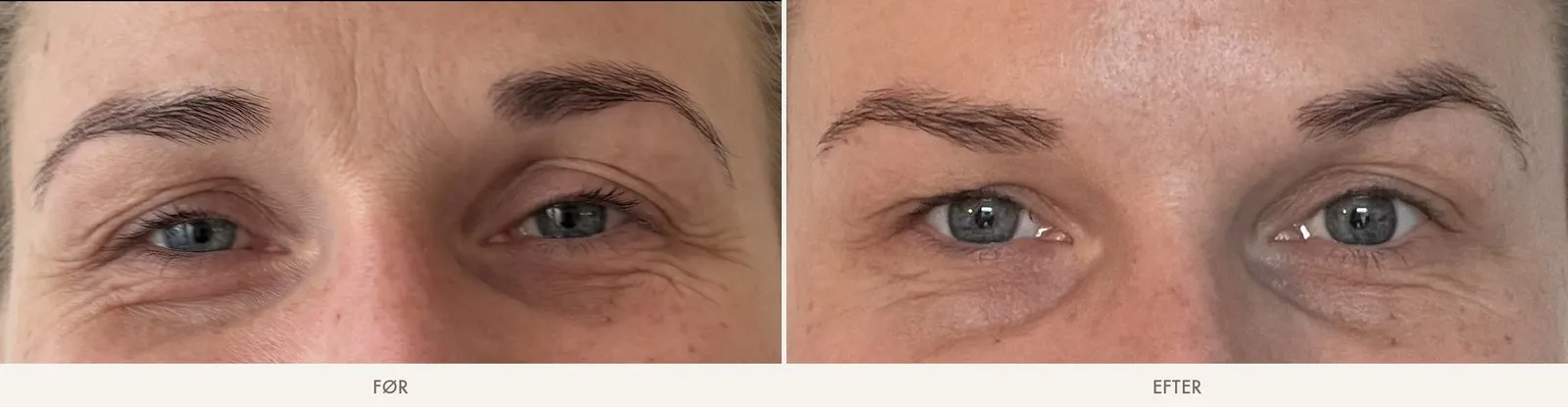Øjenparti før og efter Botox-brynløft set tæt på