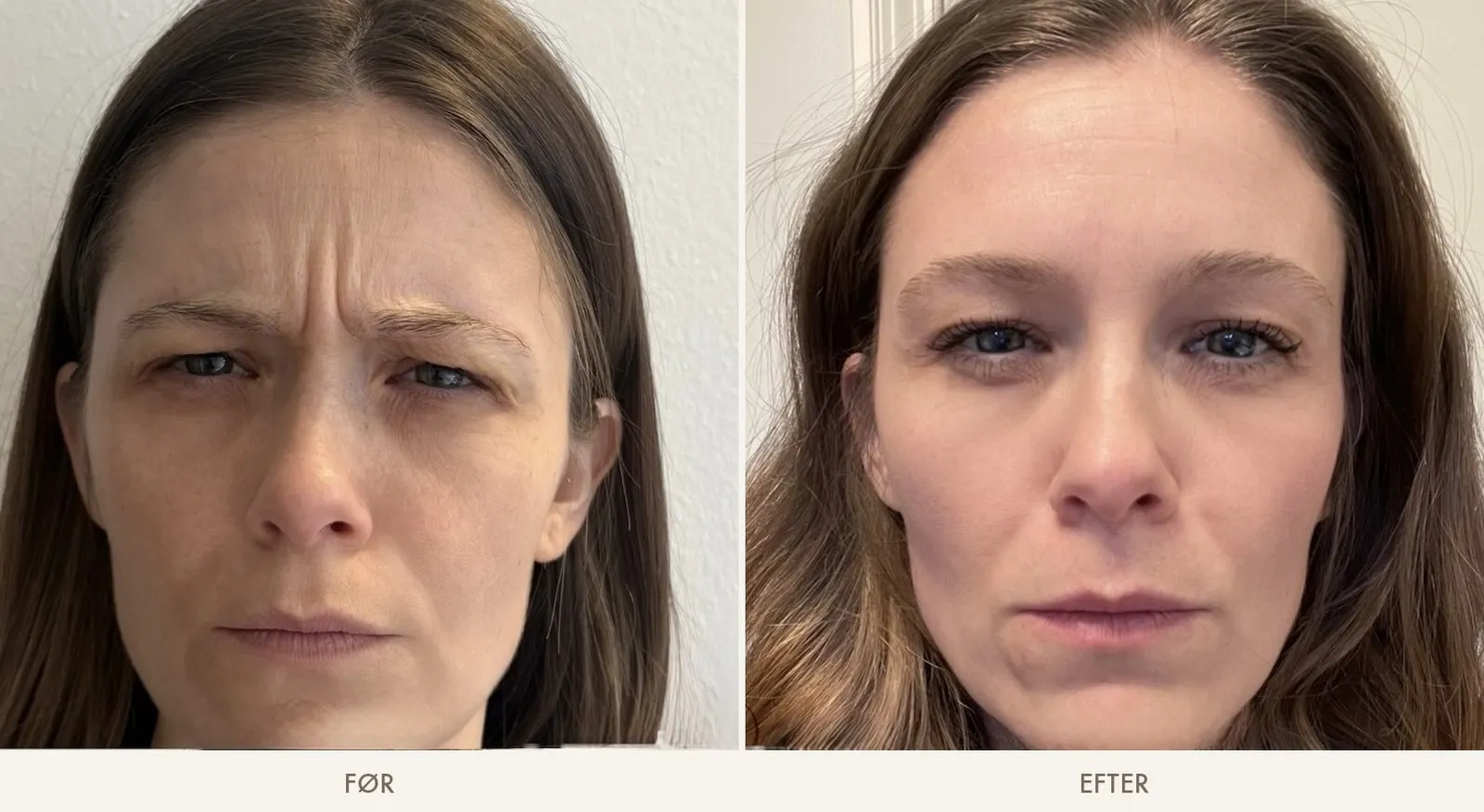 Bekymringsrynken mellem brynene før og efter Botox