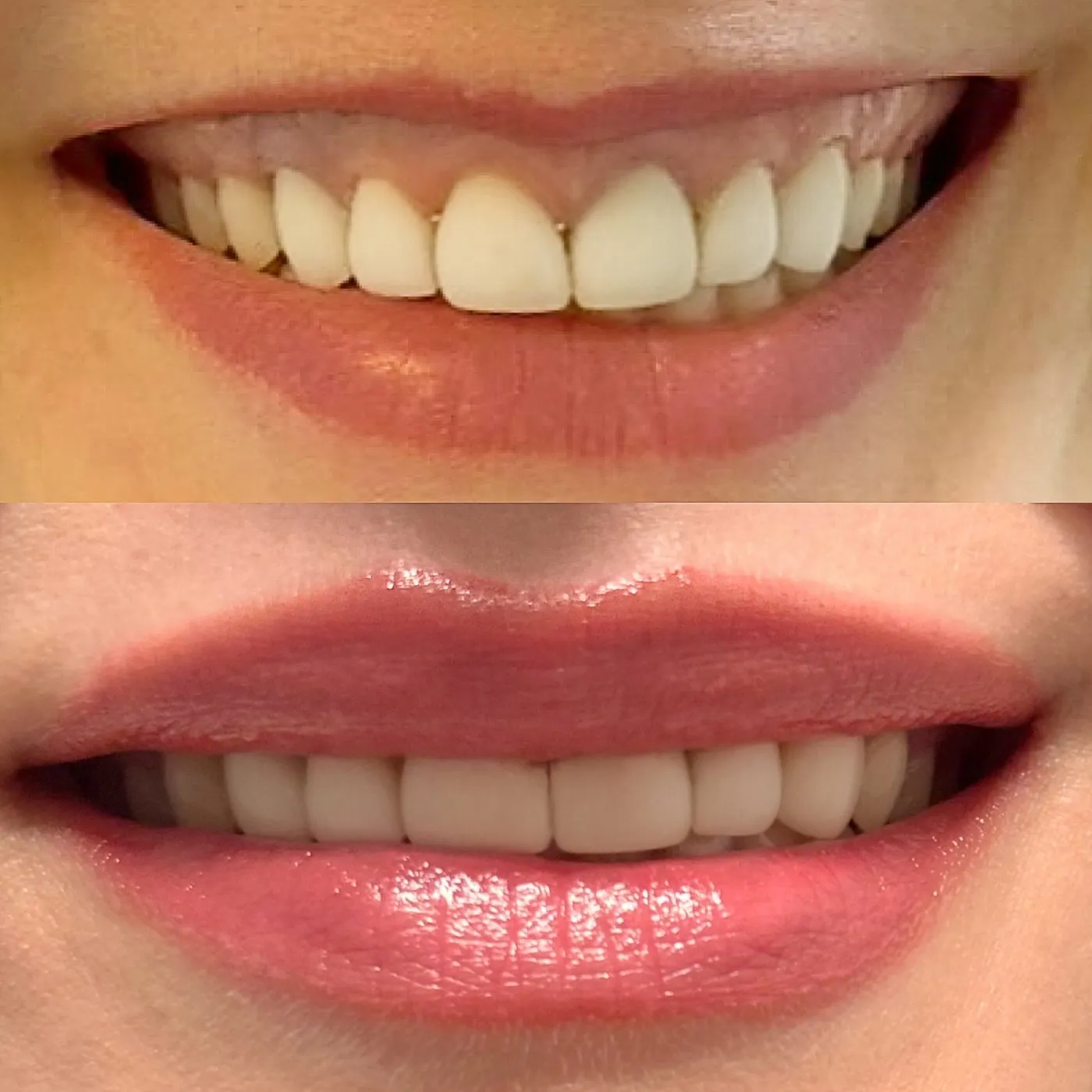 Smil før og efter kombineret gummy smile-behandling og lip flip
