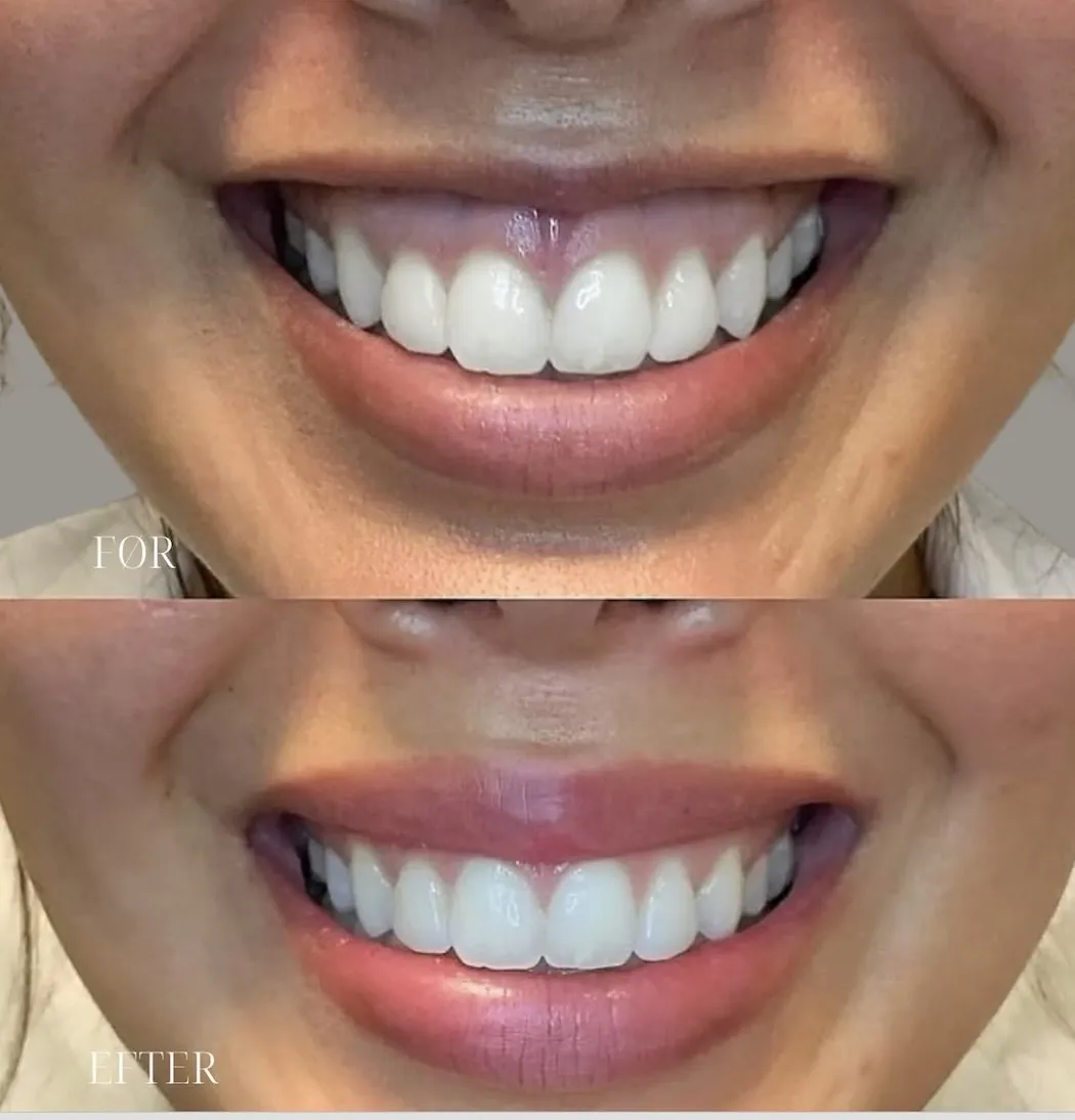 Smil før og efter Botox mod gummy smile