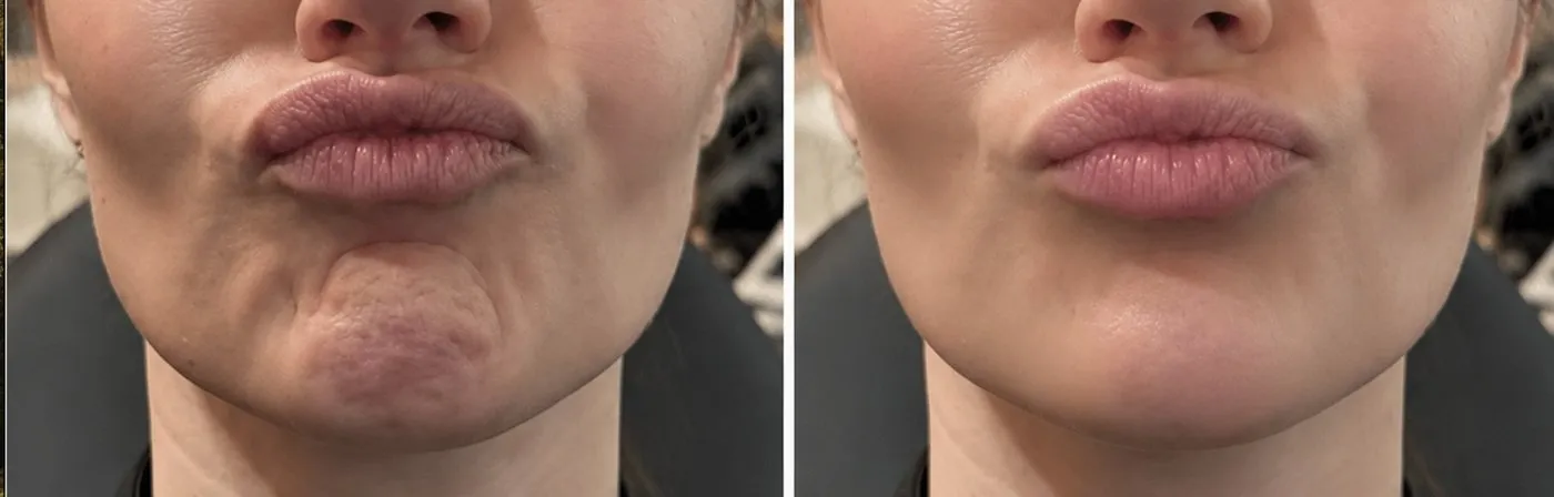 Hage før og efter Botox i mentalis-musklen — kvinde