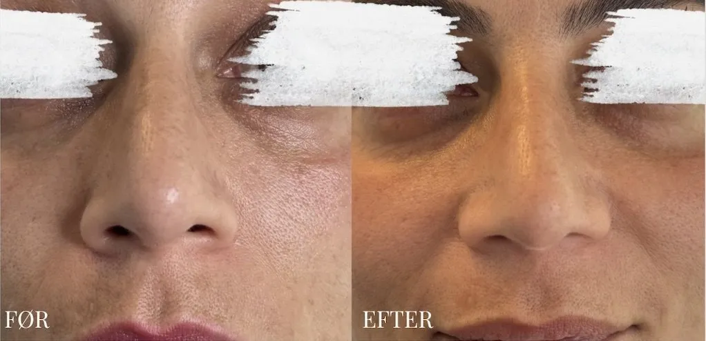 Næse før og efter nose slimming med Botox