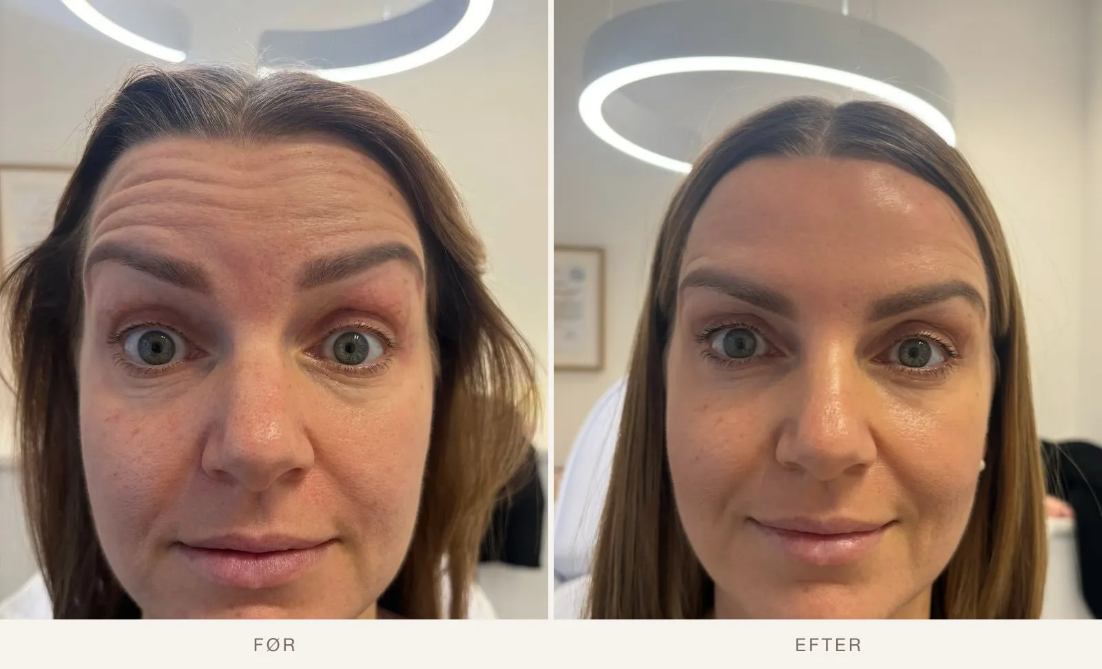 Vandrette pandelinjer før og efter Botox