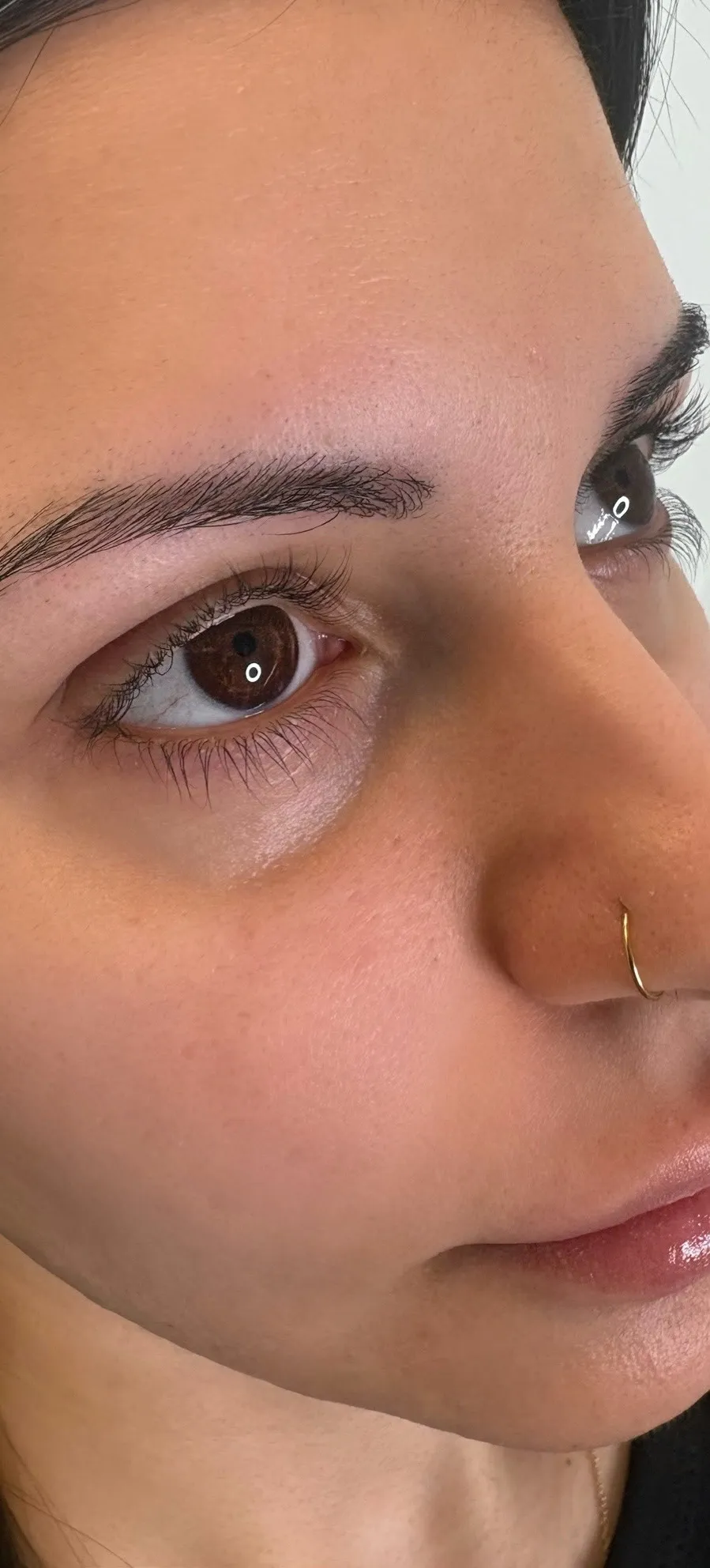 Underøjenområde og kind — tear trough-filler — før behandling